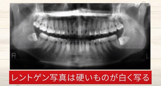 歯の神経が生きているか死んでいるかの確認方法｜香川県高松市の吉本歯科医院