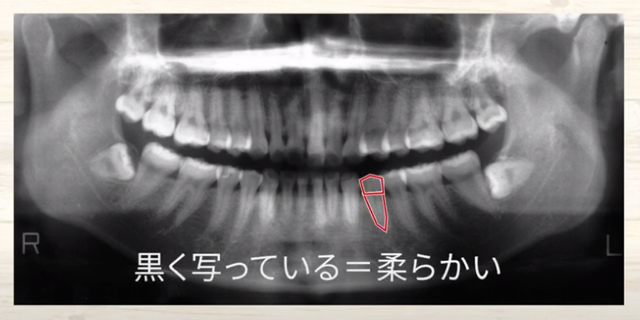 歯の神経が生きているか死んでいるかの確認方法｜香川県高松市の吉本歯科医院