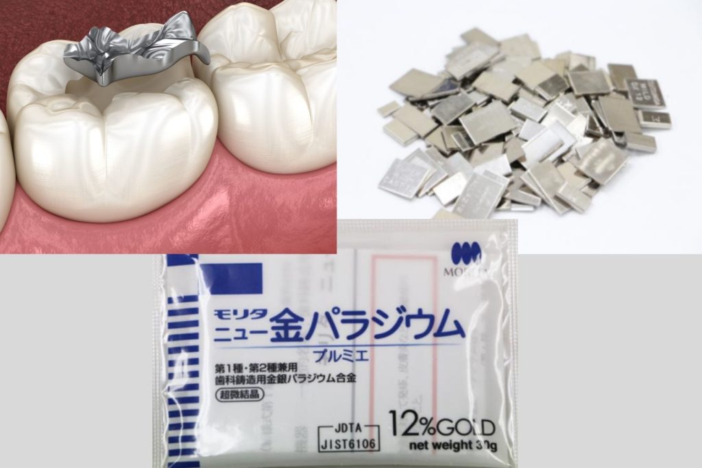口の中に銀歯を入れない理由｜香川・高松の吉本歯科医院
