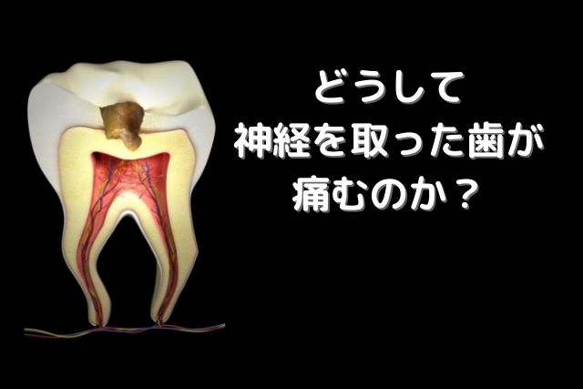 どうして神経を取った歯が痛むのか？｜香川県高松市　薬で治す虫歯治療　根管治療　歯の神経治療　吉本歯科医院