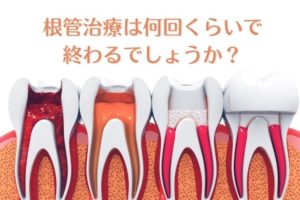 根管治療は何回くらいで終わるでしょうか？｜香川県高松市　薬で治す虫歯治療　根管治療　歯の神経治療　吉本歯科医院