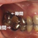 虫歯が再発する理由｜高松市の吉本歯科医院