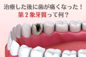 治療した後に歯が痛くなった！第２象牙質って何？｜香川県高松市　薬で治す虫歯治療　根管治療　歯の神経治療　吉本歯科医院