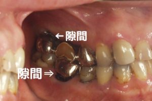虫歯が再発する理由｜高松市の吉本歯科医院